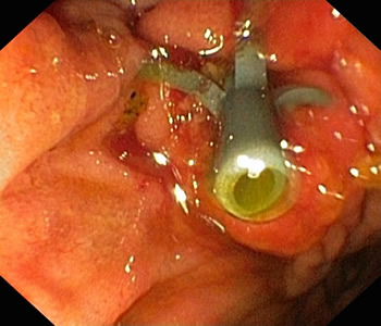 不负台胞信任——我院肝胆胰外科为其成功施行无X线下ERCP术 不负台胞信任——我院肝胆胰外科为其成功施行无X线下ERCP术