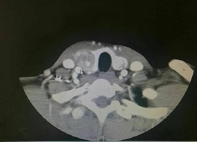『改善医疗服务行动纪实』--甲状腺乳腺外科张惠灏副主任医师采用改良法开展甲状腺癌颈部淋巴结清扫术 『改善医疗服务行动纪实』--甲状腺乳腺外科张惠灏副主任医师采用改良法开展甲状腺癌颈部淋巴结清扫术