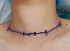 『改善医疗服务行动纪实』--甲状腺乳腺外科张惠灏副主任医师采用改良法开展甲状腺癌颈部淋巴结清扫术 『改善医疗服务行动纪实』--甲状腺乳腺外科张惠灏副主任医师采用改良法开展甲状腺癌颈部淋巴结清扫术