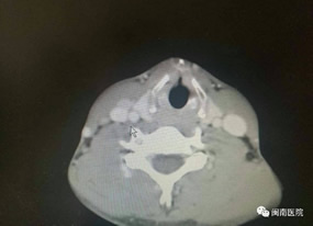 『改善医疗服务行动纪实』--甲状腺乳腺外科张惠灏副主任医师采用改良法开展甲状腺癌颈部淋巴结清扫术 『改善医疗服务行动纪实』--甲状腺乳腺外科张惠灏副主任医师采用改良法开展甲状腺癌颈部淋巴结清扫术