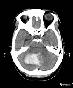 『改善医疗服务行动纪实』--小脑出血危在旦夕之际 “神医”出手解救燃眉之急 『改善医疗服务行动纪实』--小脑出血危在旦夕之际 “神医”出手解救燃眉之急
