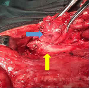 我院成功开展福建省首例颈动脉侵犯的喉恶性肿瘤动脉重建术 我院成功开展福建省首例颈动脉侵犯的喉恶性肿瘤动脉重建术
