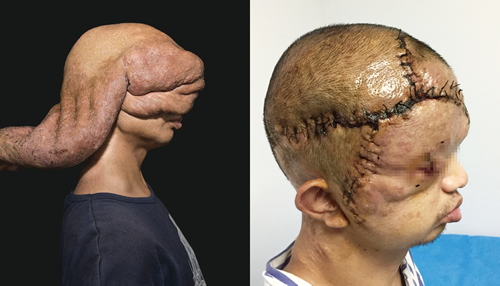 “顶着‘墨鱼脑袋’靠触觉生活22年”追踪--闽清小伙彻底告别“墨鱼头” “顶着‘墨鱼脑袋’靠触觉生活22年”追踪--闽清小伙彻底告别“墨鱼头”