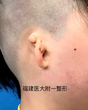 福建医大附一医院整形外科王美水主任医师在韩国大邱加图立大学医学中心(DCUMC)成功开展该院首例小耳症Nagata法耳再造手术