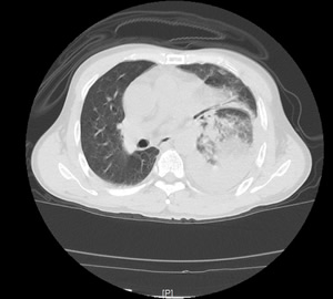 努力践行新医改，把分级诊疗和双向转诊落到实处——记一例车祸多发伤急危重症患者的MDT救治