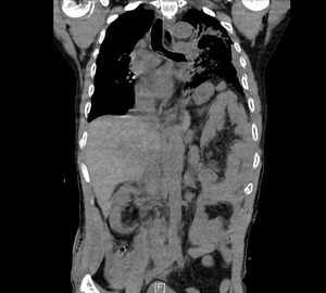 努力践行新医改，把分级诊疗和双向转诊落到实处——记一例车祸多发伤急危重症患者的MDT救治