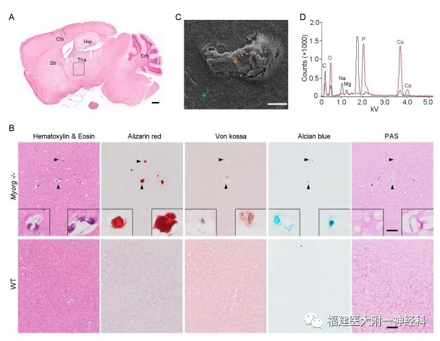 国际神经科学领域顶级期刊“Neuron”发表我院陈万金团队最新研究成果——发现原发性家族性脑钙化症首个隐性遗传致病基因 国际神经科学领域顶级期刊“Neuron”发表我院陈万金团队最新研究成果——发现原发性家族性脑钙化症首个隐性遗传致病基因