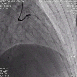 双向转诊显奇效——我院胸痛中心20分钟开通急性心梗患者血管