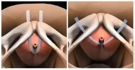 【改善医疗服务行动】我院泌尿外科成功开展无张力尿道悬吊微创手术为压力性尿失禁患者带来福音 【改善医疗服务行动】我院泌尿外科成功开展无张力尿道悬吊微创手术为压力性尿失禁患者带来福音