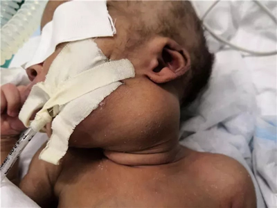 『援非事迹』非洲新生儿患上罕见病,福建援博医生勇“拆弹” 『援非事迹』非洲新生儿患上罕见病,福建援博医生勇“拆弹”