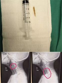 『援非事迹』非洲新生儿患上罕见病,福建援博医生勇“拆弹” 『援非事迹』非洲新生儿患上罕见病,福建援博医生勇“拆弹”