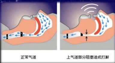 鼾友之约——我院睡眠中心治疗睡眠打鼾情况 鼾友之约——我院睡眠中心治疗睡眠打鼾情况