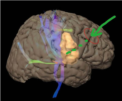 穿越“束”缚　精准“窃”除——我院神经外科应用功能神经导航辅助下Endoport内镜新技术为患者成功切除脑深部海绵状血管瘤