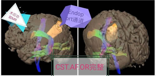 穿越“束”缚　精准“窃”除——我院神经外科应用功能神经导航辅助下Endoport内镜新技术为患者成功切除脑深部海绵状血管瘤