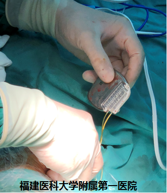 疼痛到什么部位，手术就控制到什么部位 ——我院神经外科林章雅教授带领团队精准施治脊髓损伤后顽固性疼痛