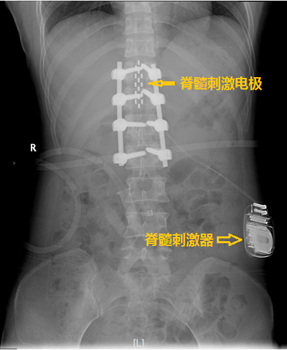 疼痛到什么部位，手术就控制到什么部位 ——我院神经外科林章雅教授带领团队精准施治脊髓损伤后顽固性疼痛