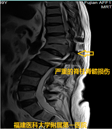 疼痛到什么部位，手术就控制到什么部位 ——我院神经外科林章雅教授带领团队精准施治脊髓损伤后顽固性疼痛