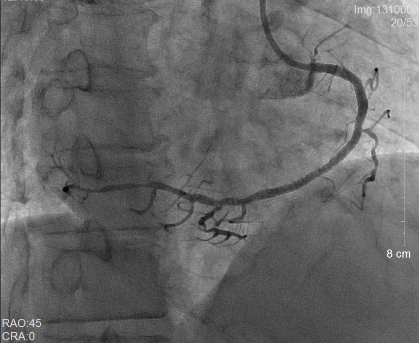 我院多学科联合成功救治一名右位心合并心肌梗死患者