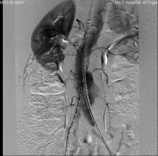 我院多学科协作成功抢救多名主动脉瘤破裂患者