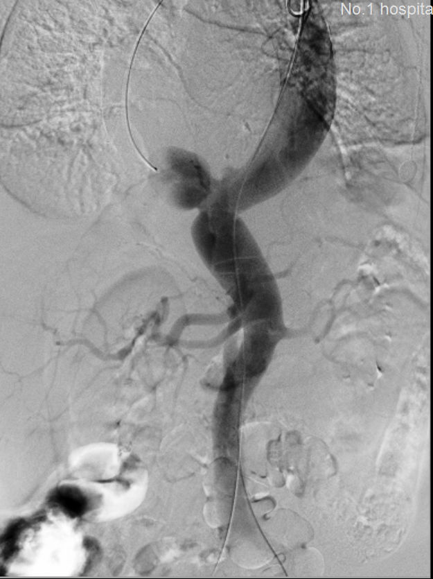 我院多学科协作成功抢救多名主动脉瘤破裂患者