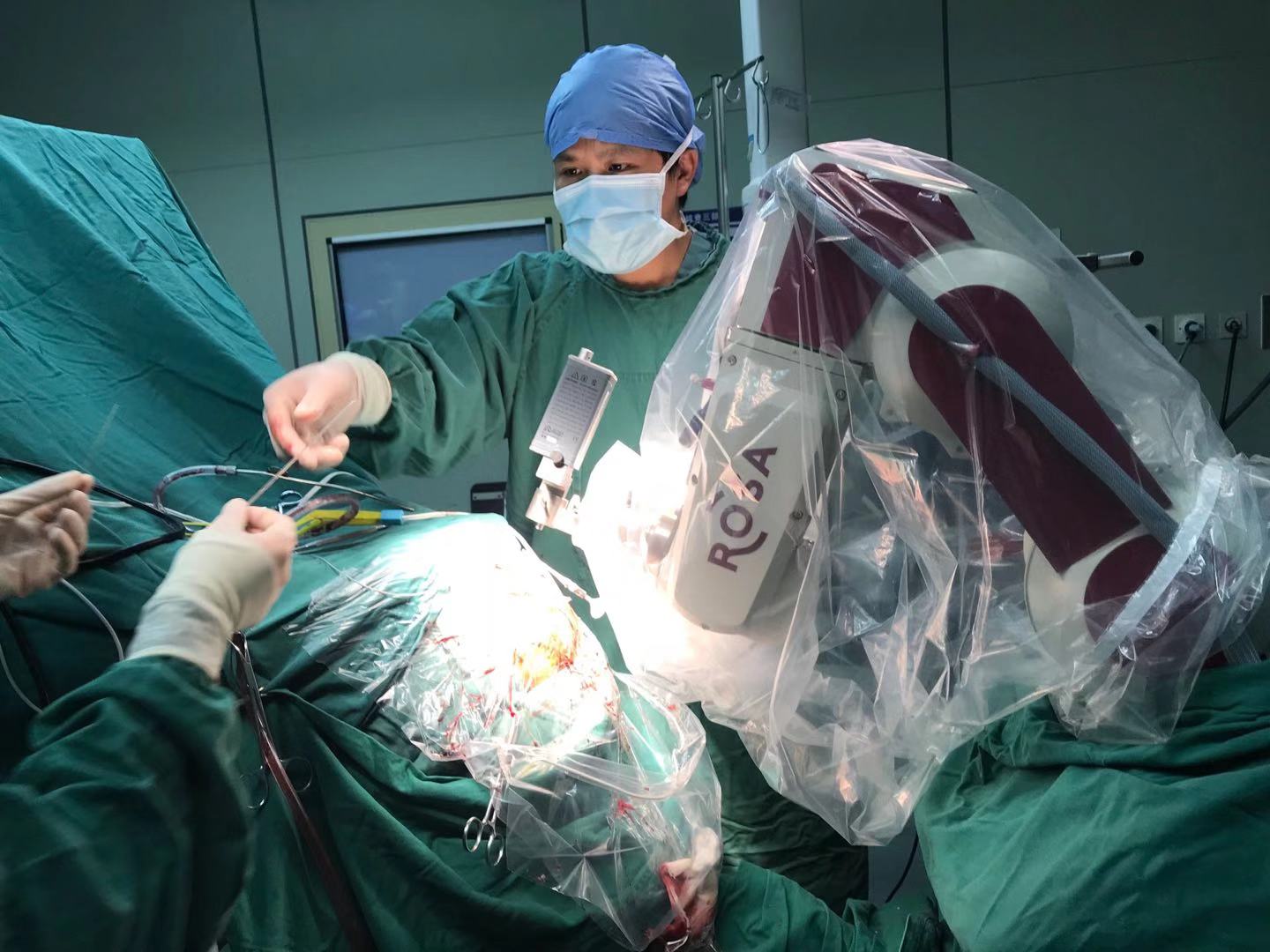 全国首例！我院利用国际新技术ROSA机器人 植入丘脑前核脑起搏器电极治疗癫痫