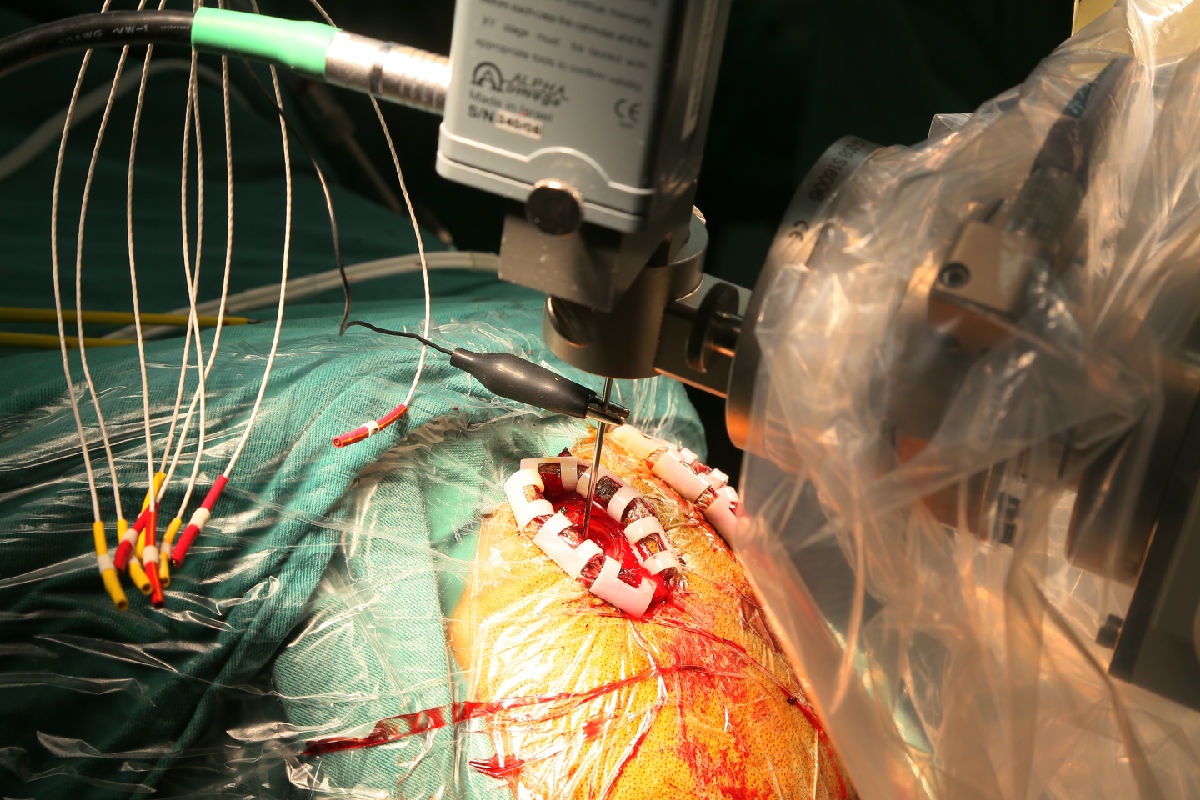 全国首例！我院利用国际新技术ROSA机器人 植入丘脑前核脑起搏器电极治疗癫痫