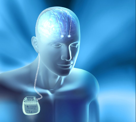 全国首例！我院利用国际新技术ROSA机器人 植入丘脑前核脑起搏器电极治疗癫痫