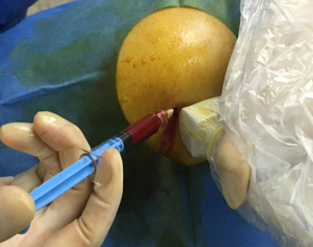 人体自带的神奇修复血浆PRP ——缓解关节疼痛，修复肌腱损伤，加速创面愈合