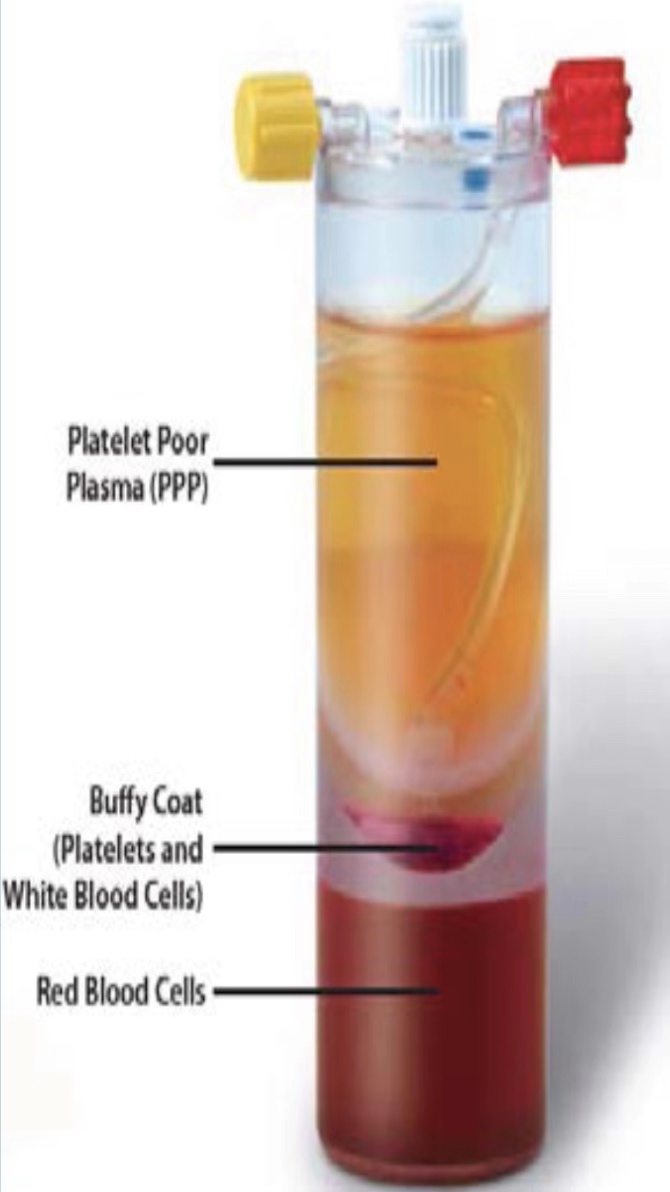 人体自带的神奇修复血浆PRP ——缓解关节疼痛，修复肌腱损伤，加速创面愈合