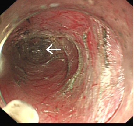 一根“流浪”的鱼刺，一场多学科协作的搜寻 ——我院采用隧道内镜技术完成食管黏膜下异物探查