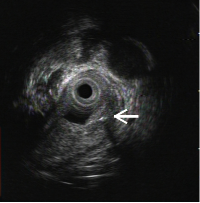 一根“流浪”的鱼刺，一场多学科协作的搜寻 ——我院采用隧道内镜技术完成食管黏膜下异物探查