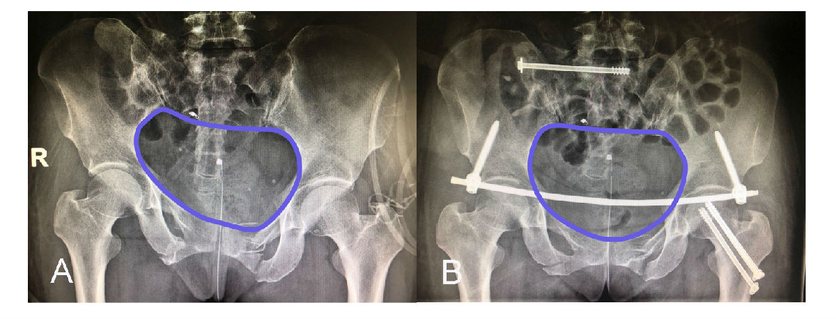 Starr架复位系统“暗箱操纵”巧治骨盆骨折