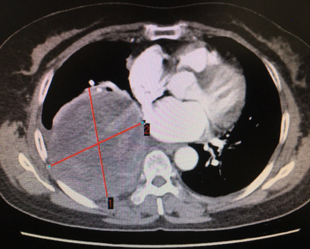 胸外科“拆弹”专家再拆除重磅“炸弹”