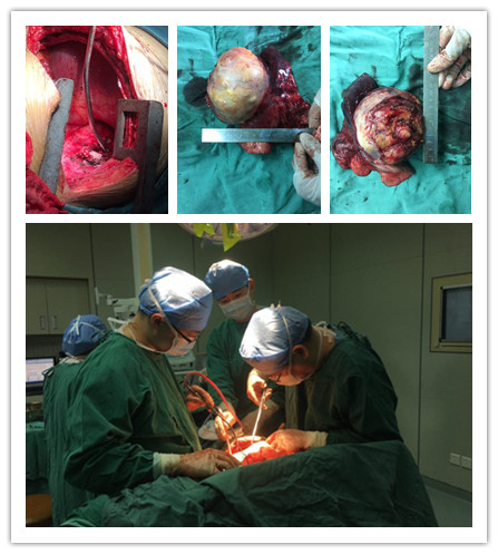 胸外科“拆弹”专家再拆除重磅“炸弹”