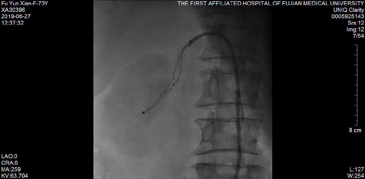 我院心内科又成功救治一例尿毒症难治性高血压合并冠状动脉严重病变患者 我院心内科又成功救治一例尿毒症难治性高血压合并冠状动脉严重病变患者