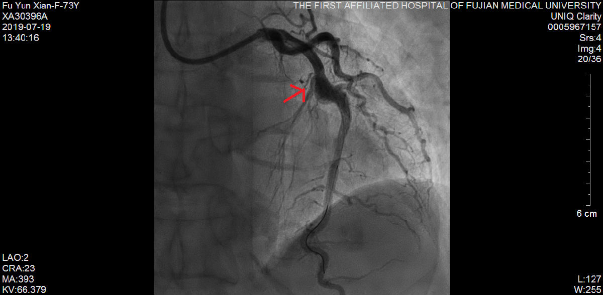 我院心内科又成功救治一例尿毒症难治性高血压合并冠状动脉严重病变患者 我院心内科又成功救治一例尿毒症难治性高血压合并冠状动脉严重病变患者