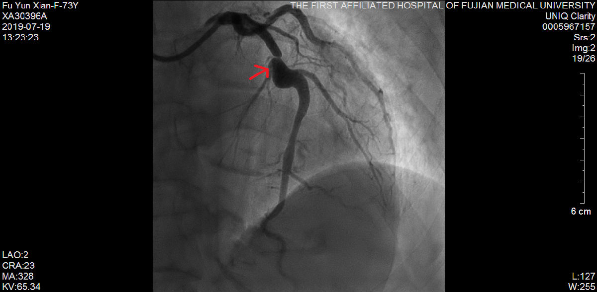 我院心内科又成功救治一例尿毒症难治性高血压合并冠状动脉严重病变患者 我院心内科又成功救治一例尿毒症难治性高血压合并冠状动脉严重病变患者