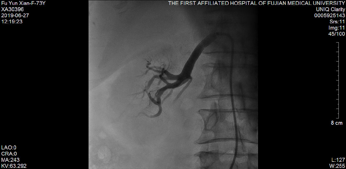 我院心内科又成功救治一例尿毒症难治性高血压合并冠状动脉严重病变患者 我院心内科又成功救治一例尿毒症难治性高血压合并冠状动脉严重病变患者