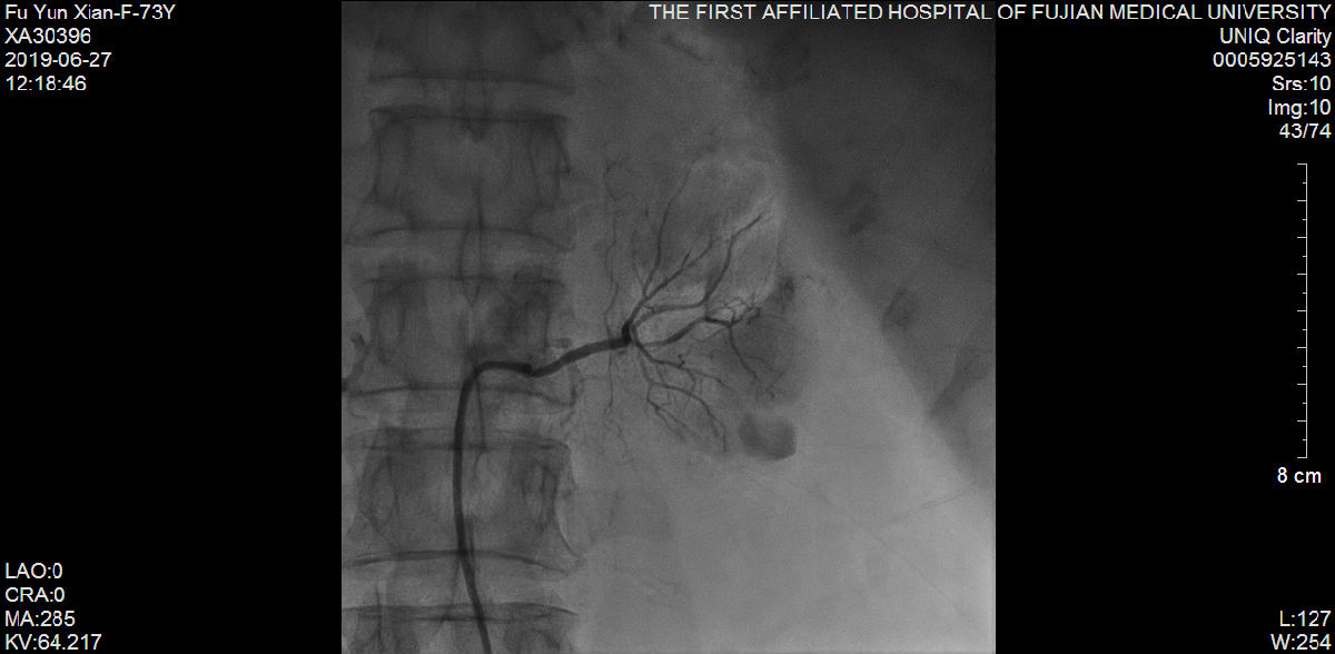 我院心内科又成功救治一例尿毒症难治性高血压合并冠状动脉严重病变患者 我院心内科又成功救治一例尿毒症难治性高血压合并冠状动脉严重病变患者
