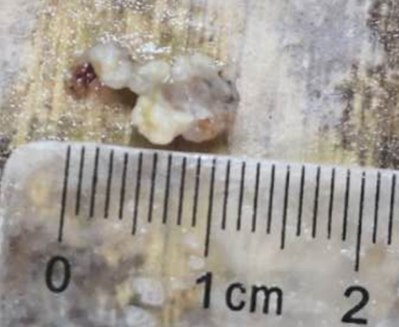 我院援宁队员郑小斌联手当地医院神经脊柱外科完成高难度脊髓髓内血管性肿瘤切除手术 我院援宁队员郑小斌联手当地医院神经脊柱外科完成高难度脊髓髓内血管性肿瘤切除手术