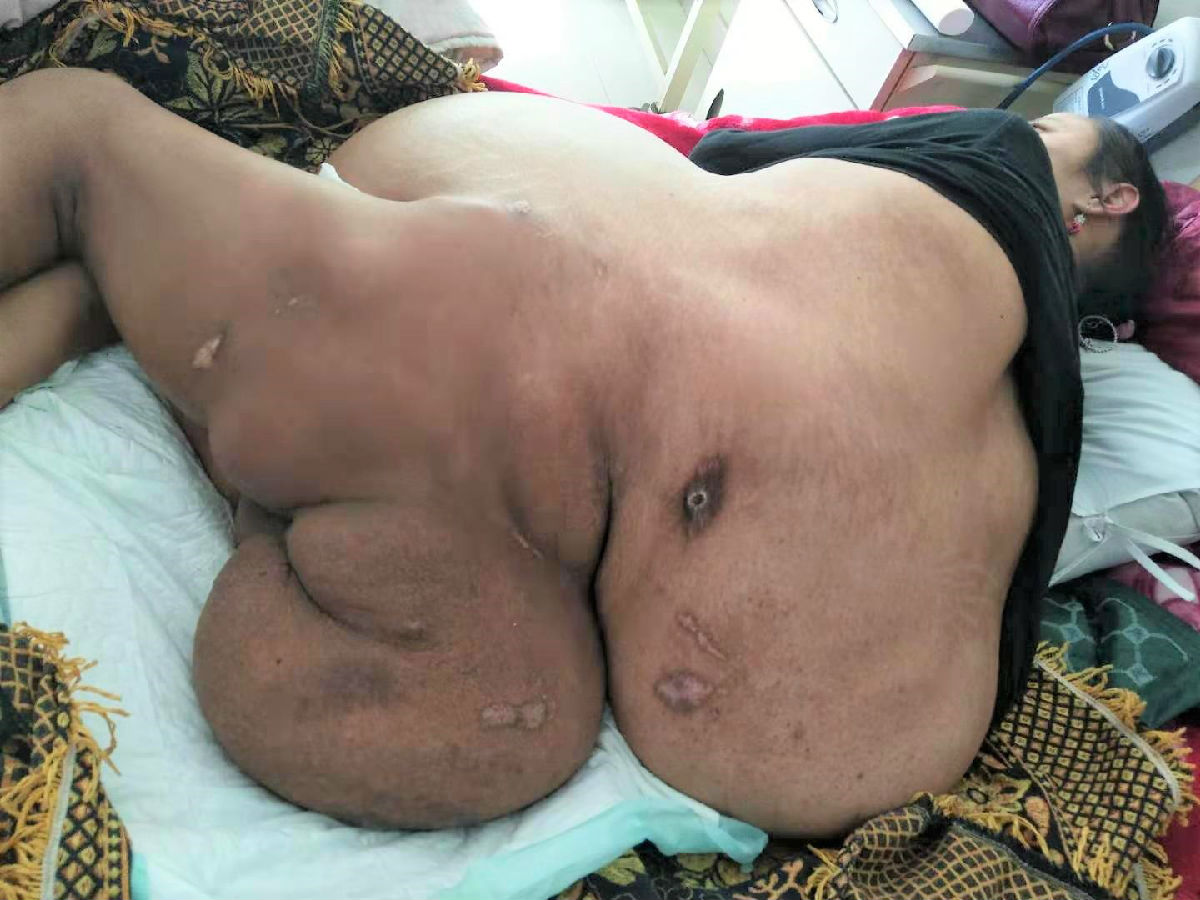 我院援宁医疗队合力救治神经管畸形合并巨大腹腔肿瘤患者