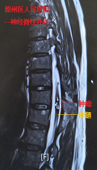 我院援宁队员郑小斌联手当地医院 完成高级别脊髓内血管性肿瘤切除手术