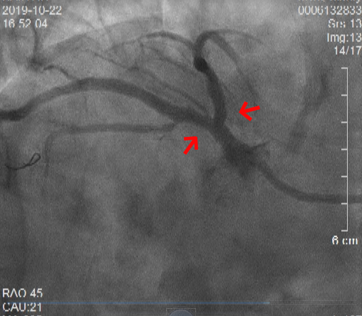92岁罕见“镜面人”心肌梗死 我院心内科团队成功为其完成左主干分叉病变双支架治疗