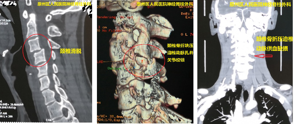 精准“制导”  我院援宁队员郑小斌协助当地医院神经脊柱外科实施颈椎“椎弓根置钉”术成功救治颈椎骨折滑脱患者
