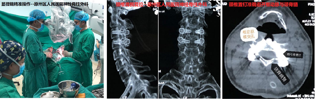 精准“制导”  我院援宁队员郑小斌协助当地医院神经脊柱外科实施颈椎“椎弓根置钉”术成功救治颈椎骨折滑脱患者