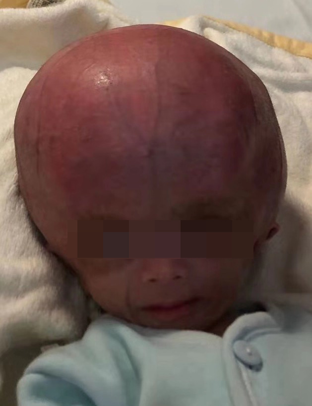 “大头大头”下雨不愁，却愁坏了这家子 —— 神外医护齐上阵，圆“大头”娃娃健康梦