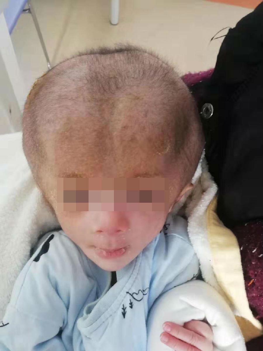 “大头大头”下雨不愁，却愁坏了这家子 —— 神外医护齐上阵，圆“大头”娃娃健康梦