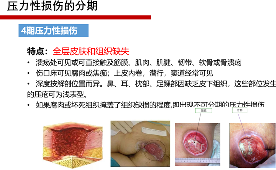 夯实基础护理 精进压疮管理                —护理部开展首次压力性损伤横断面调查工作 