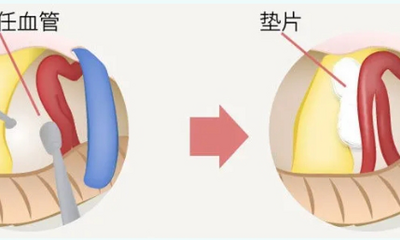 『附一科普』面部不自觉“跳一跳”，可能是面肌痉挛的征兆